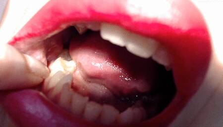 Extremely ragged teeth