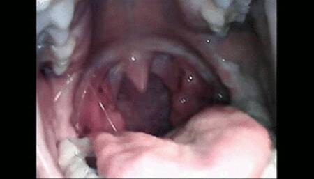 Endoscopic belching wmv