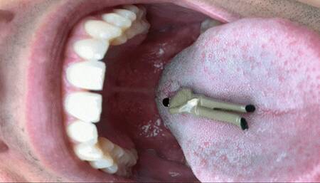 Jason Pierce Swallows Tiny Patient- MKV