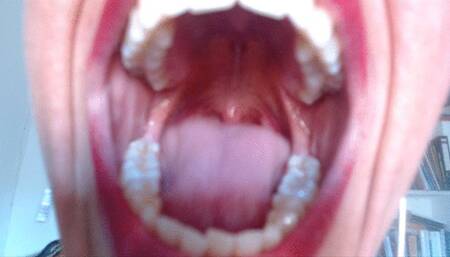 flicking uvula & strong gag reflex