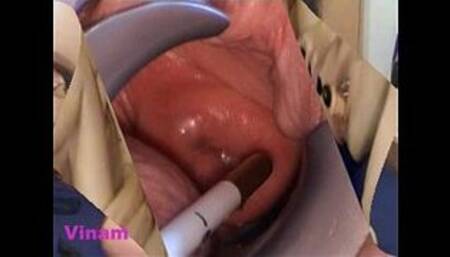 Extreme Fisting and Huge Japanese Objetcs Insertions