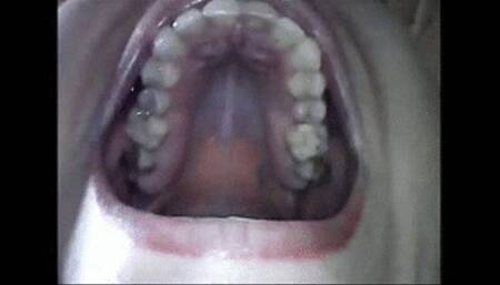 Endoscopic yawning wmv