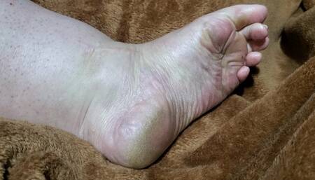 swollen dirty toe clamps