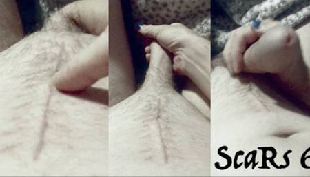 scar fetish - fourth post surgery masturbation withOUT bandages