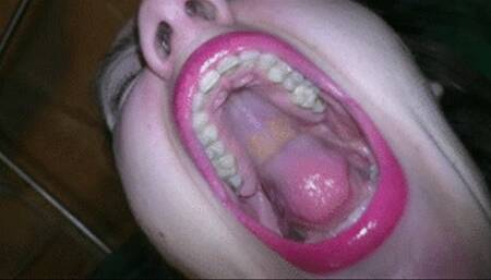 Extreme attack of yawning