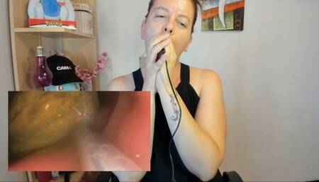 The stone of the fruit - Endoscope vore avi