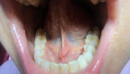 Large tongue salivary calculus avi