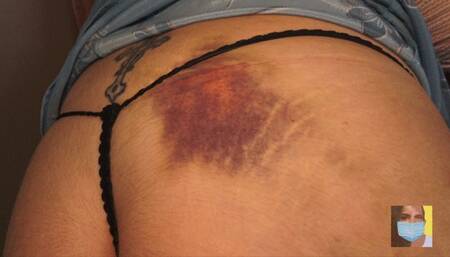 Ice my Pain in the Ass