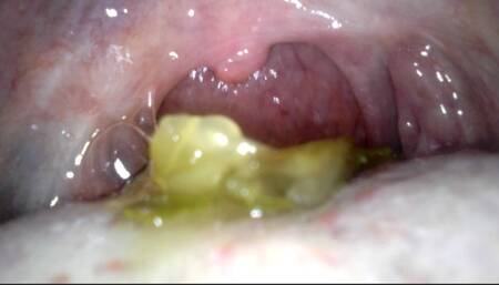 Endoscope food vore pickles cheese