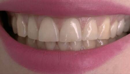 The edges of your incisors are so extremely sharp MP4 HD 720p