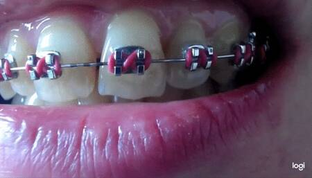Teeth with brazes on No audio No sound mp4
