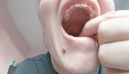 Big tonsil stones mine