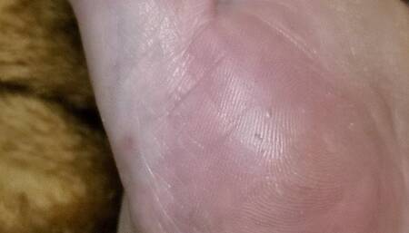 Update on the state of my foot