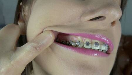 Weronika - 2 Weeks Braces - Extreme Close-Ups - UHD 3840x2160 - 4K