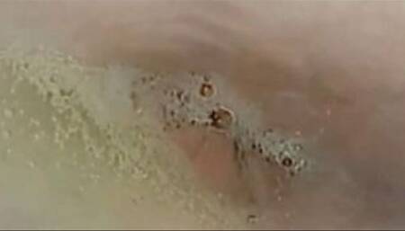 In loop inside my troath with endoscope
