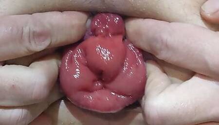 Pumping my anal prolapse