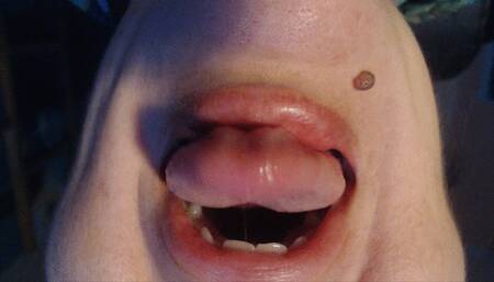 Inverted tongue