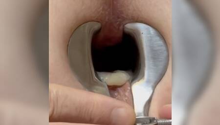 Cumdump playing with speculum draining hole