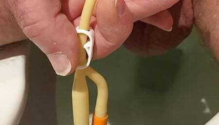 Bladder squeeze then drain with Fr16 catheter