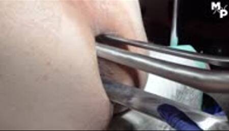 Extremely anal stretching with a giant speculum