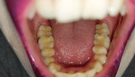 teeth tour - purple lips