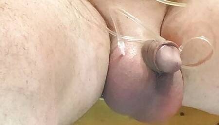 Saline Glucose Infusion