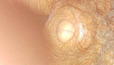 30 Fr catheter in tiny bi mtf cock