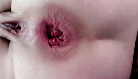 Fisting my gaping asshole et pussyhole and prolapse