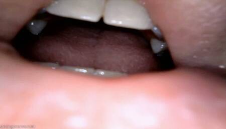 burp endoscopy (720 mp4)