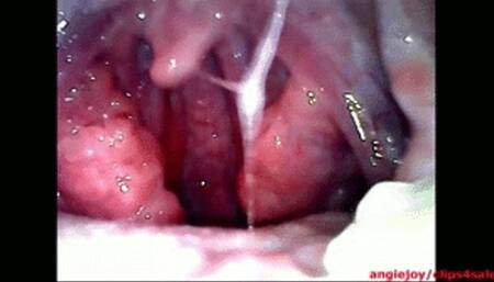 choking phlegm ENDOSCOPY