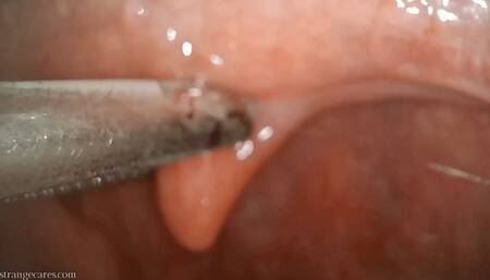 uvula manipulation with swab and forceps