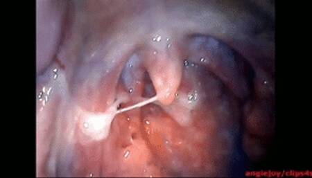 Big phlegm ENDOSCOPY wmv