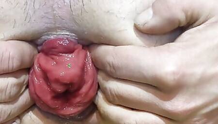 Anal prolapse pump