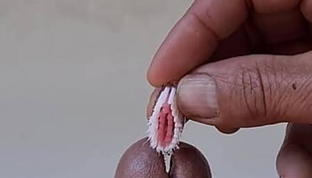 Insertion uretre