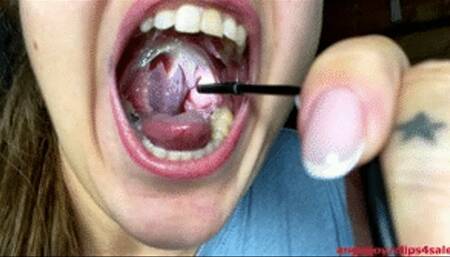 Irrigation tonsils wmv