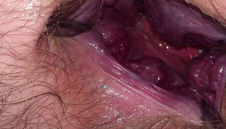 4 inch stretch cauliflower prolapse