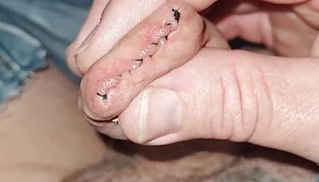 Sewn foreskin