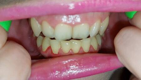 another teeth tour