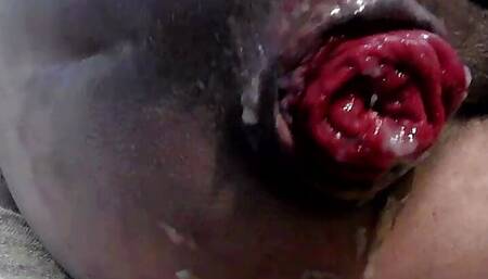 Destroying my ass again episode of anal prolapse series ASS P3 PUMP