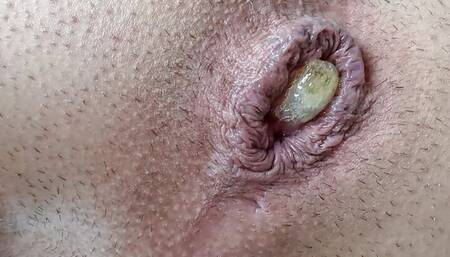 anal