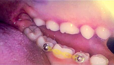 Endoscope - My First Mouth Tour (Part 2)