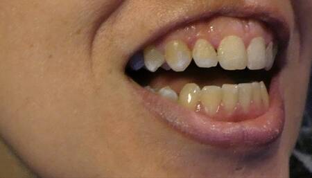 Scratch and Floss Dirty Teeth