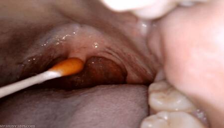 uvula cholula: direct hot sauce application with swab