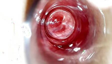 Prolapse gaping ass