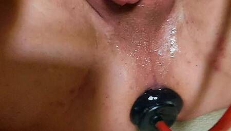 Balloon In Anal