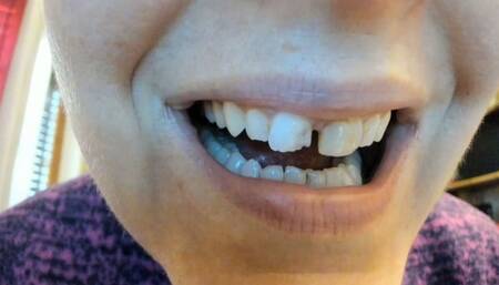 Broken incisor - real broken incisor 4K