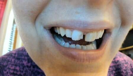 Broken incisor - real broken incisor 720HD