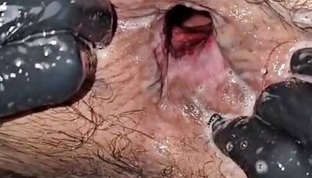 fistlovergr cavernous hole