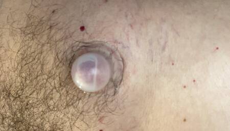 Supple Cups filling up with Serous fluid
