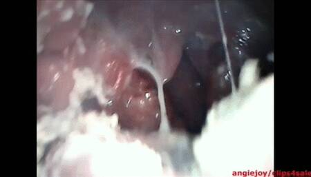 Endoscopy while crushing food